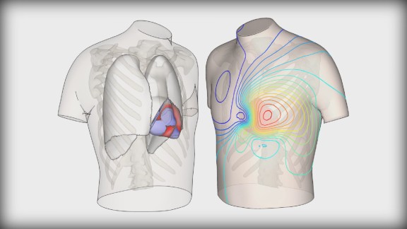 Cardiólogos y científicos de Zaragoza replicarán copias virtuales de corazones enfermos para prevenir muertes súbitas