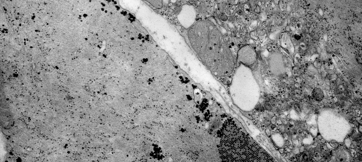 Imagen al microscopio de un enterovirus de la familia Coxsaquievirus (EP).