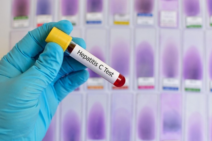 Test para hepatitis C. / Europa Press